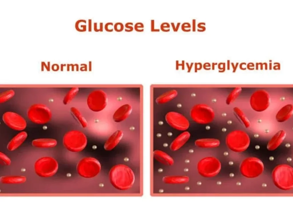 Hyperglycemia: Understanding High Blood Sugar