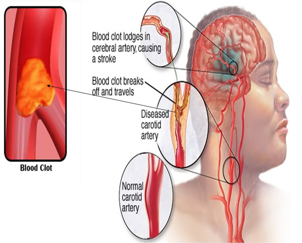 Embolic Stroke: A Type of Ischemic Stroke