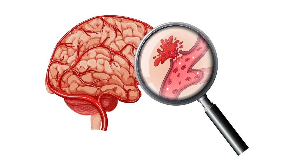 Hemorrhagic Stroke: A Life-Threatening Condition