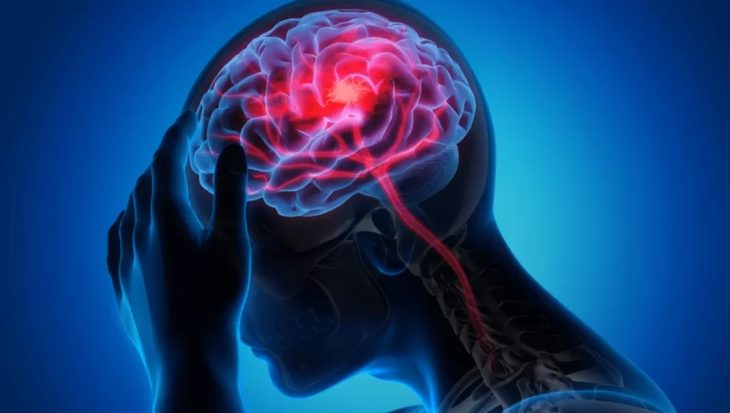 Ischaemic Stroke: A Comprehensive Guide