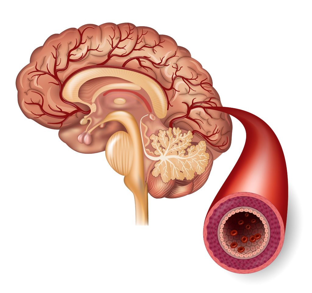 Transient Ischaemic Attack (TIA): A Warning Sign for Stroke